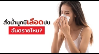 ไซนัสอักเสบ