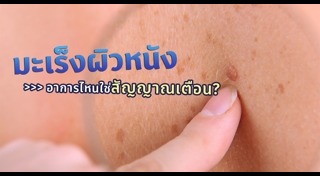 มะเร็งผิวหนัง