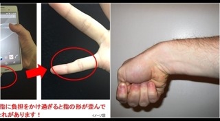 เอ็นอักเสบ