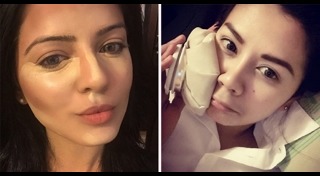 วิธีลดถุงใต้ตา