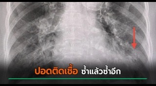 ปอดติดเชื้อ