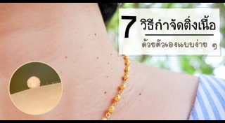 ติ่งเนื้อ