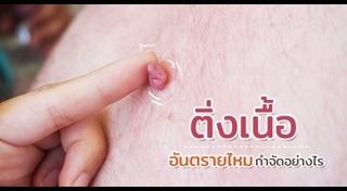 ติ่งเนื้อ