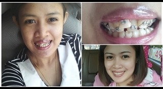 รีวิวจัดฟัน