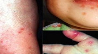 โรคมือเท้าปาก